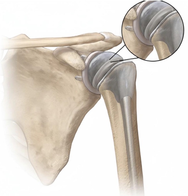Life after shoulder replacement surgery in Bangalore